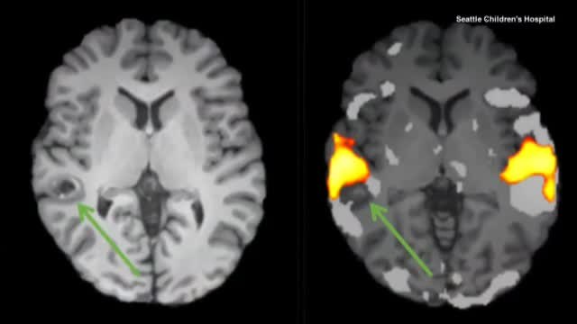 Una joven de 19 años canta mientras le quitan un tumor cerebral
