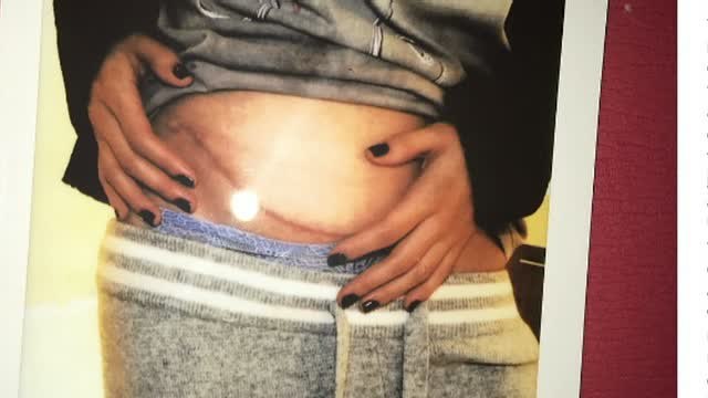 La cantante Selena Gómez sometida a un trasplante de riñón