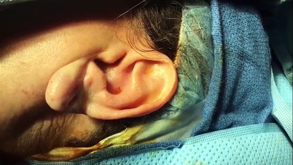 Earlobe Repair Surgery With Dr. Monica Tadros