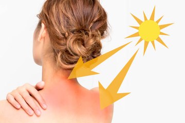 Coups de soleil : 7 remèdes naturels pour les apaiser