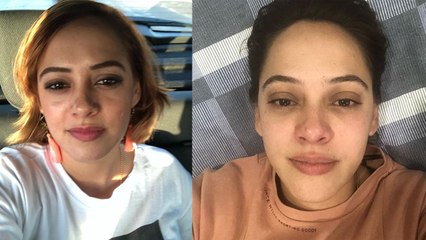 Hazel Keech undergoes Nose Surgery because of this reason : Check Out Here |FilmiBeat