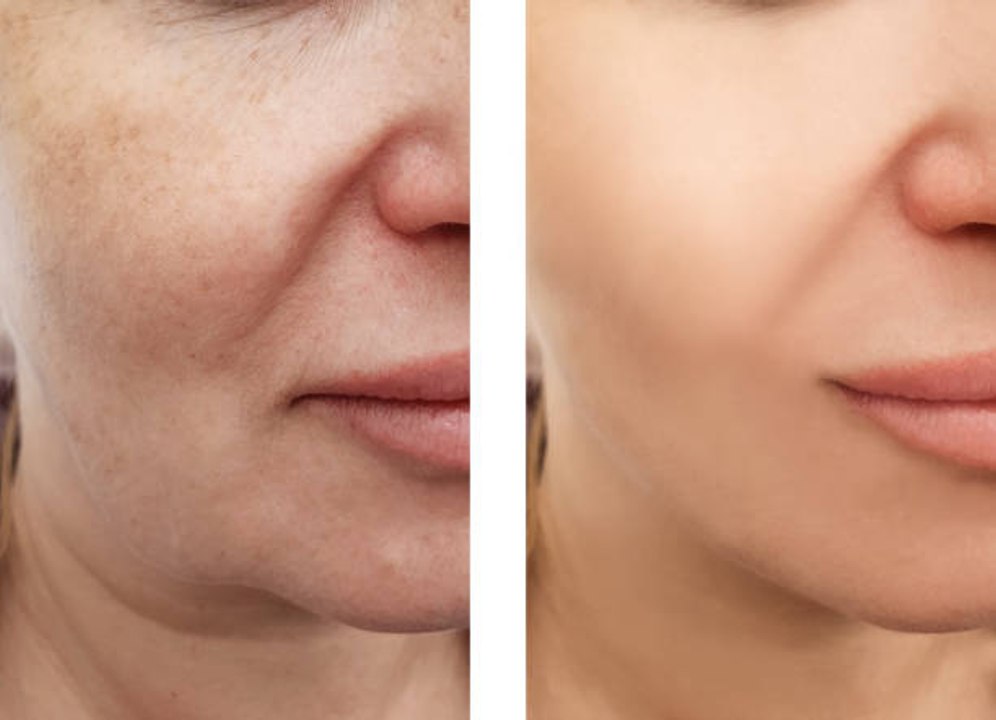 Taches brunes : 6 remèdes de grand-mère