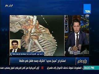 "اخترق صدره ورقبته".. تفاصيل استخراج سيخ حديد من جسد طفل بـ"طنطا الجامعي"