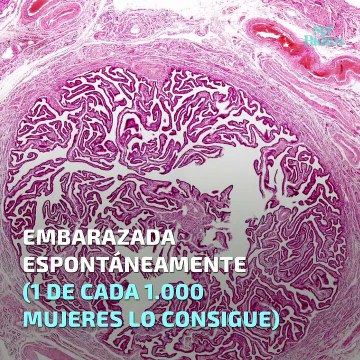 Embarazada con las trompas de falopio ligadas