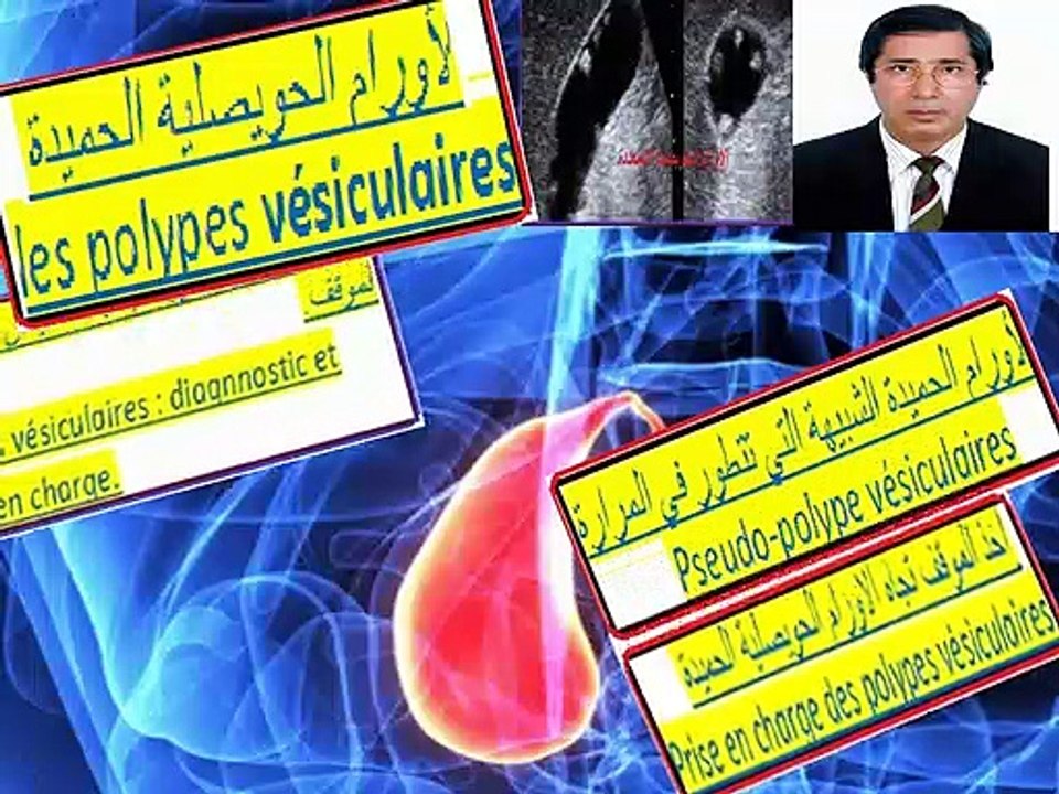 Polypes vésiculaires : diagnostic et prise en charge   بوليب المرارة