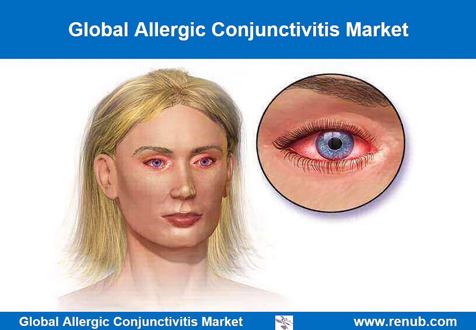 ⁣Global Allergic Conjunctivitis Market Outlook