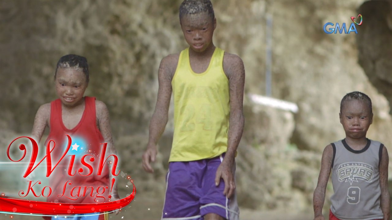 Wish Ko Lang: Mga batang may malubhang sakit sa balat, tinulungan ng 'Wish Ko Lang'