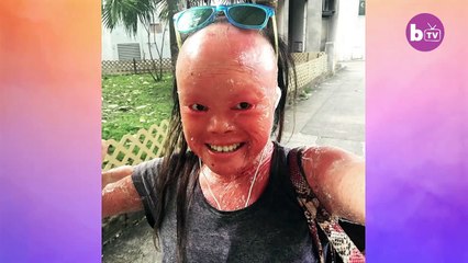 Victime d'intimidation Parce que Ma Peau se développe Trop Vite | NÉ DIFFÉRENTS | {Extreme}