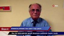 Böbreklerinde 500 adet taş çıktı