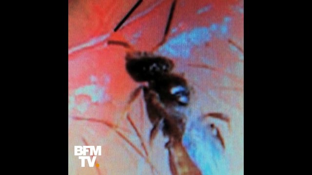 Des médecins taïwanais ont retrouvé quatre abeilles… dans l’œil d’une patiente