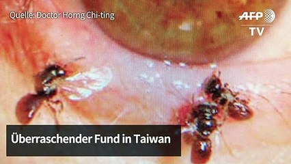 Arzt findet vier Bienen im Auge von Patientin