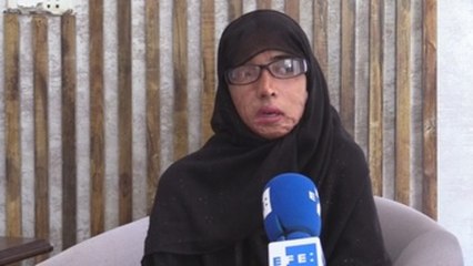 Misbah, la paquistaní empeñada en que las atacadas con ácido sonrían de nuevo