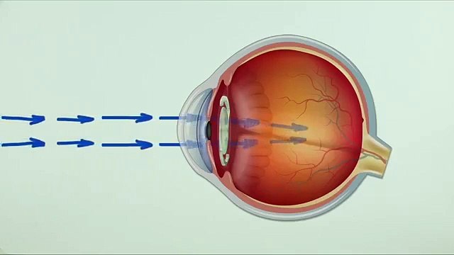 Akıllı lens nasıl takılır?