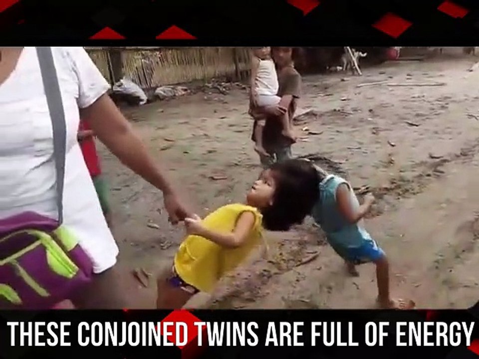 Conjoined Twins
