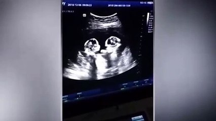 Anne karnındaki ikizler birbirine girdi