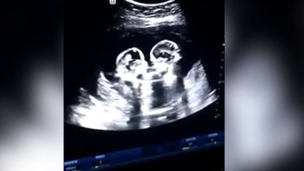 La ecografía de unas gemelas que arrasa: el ser humano es asombroso