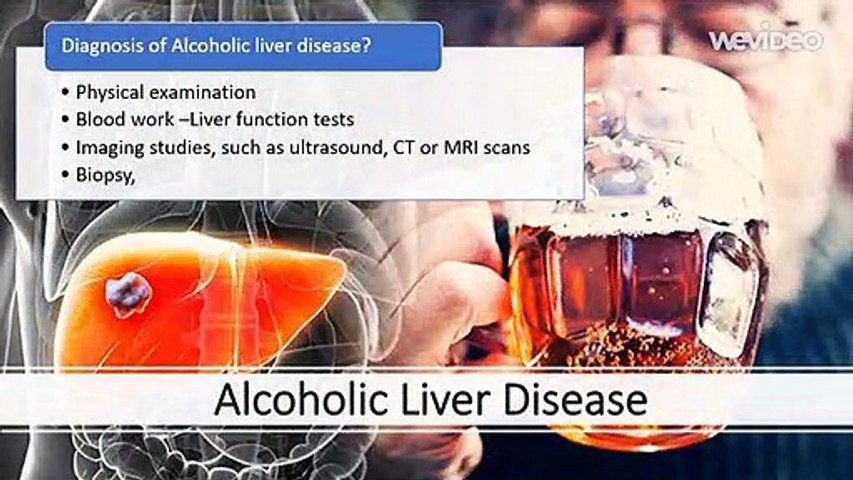 alcoholic liver disease 2