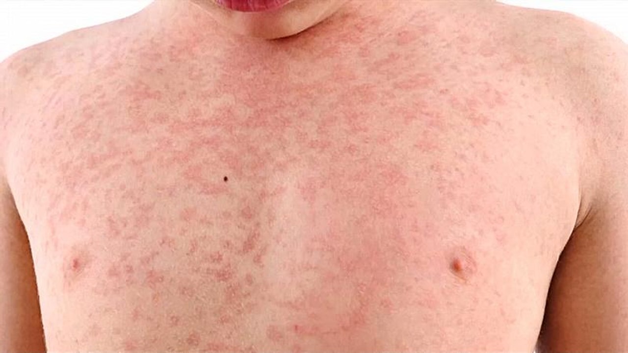 695 Fälle seit Januar: Masernhöchstwert in den USA