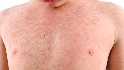 La rougeole est bel et bien de retour, les Etats-Unis particulièrement impactés