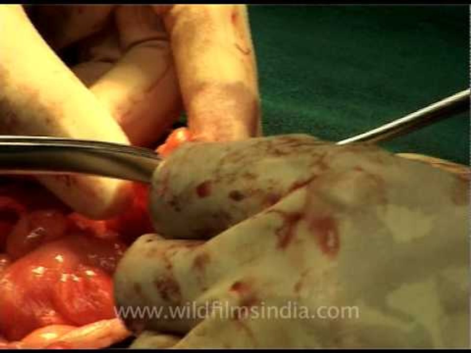 Surgery that will send chills down your spine!