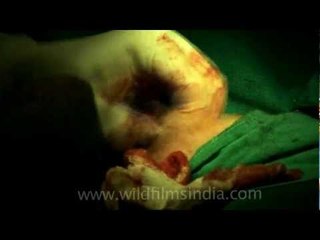 Cutting the cyst out of the breast..