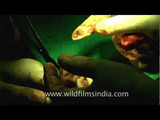 Surgery to remove Fibroids in female Breast