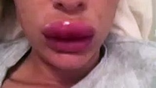 Rachael Knappier's swollen lips after a lip filler treatment went horribly wrong