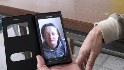 Yüzüne asit dökülen genç kız yardım bekliyor - HATAY