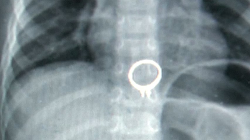 Three-year-old Chinese boy swallows mother’s diamond ring