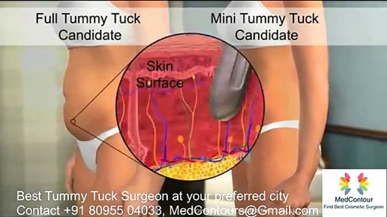 Tummy Tuck surgeon in Hyderabad. Best Tummy Tuck cost Hyderabad. Abdominoplasty  surgery Hyderabad