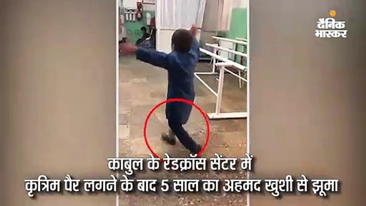 कृत्रिम पैर लगने के बाद 5 साल का बच्चा खुशी से...