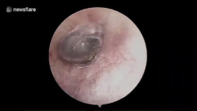 Tiny spider found building a nest in man’s ear in China in stomach-churning clip