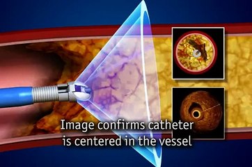 Forward_Looking_IVUS