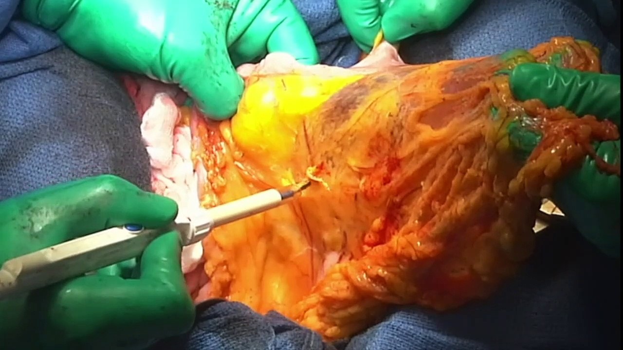Oropharyngectomie par voie cervico-transorale robot assistée, curage cervical bilatéral, reconstruction par lambeau libre antérolatéral de cuisse