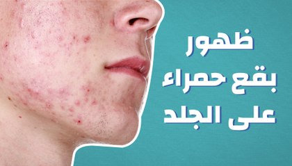 ظهور بقع حمراء على الجلد