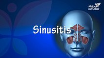 Sinusitis: causas, síntomas y tratamientos