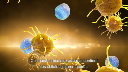 L'affection dégénérative articulaire
