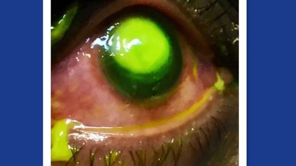 Esto es a lo que te arriesgas si duermes con las lentillas