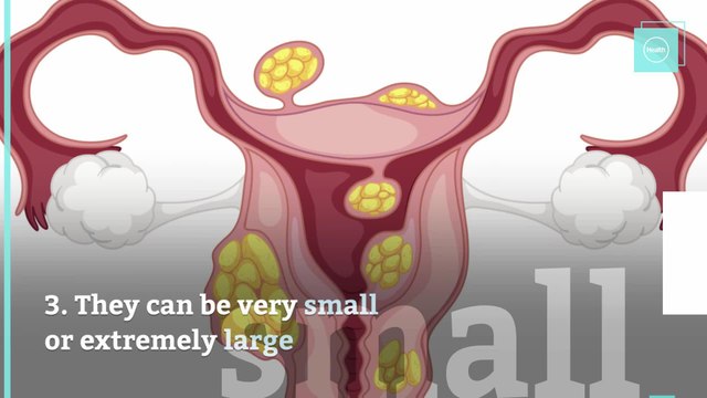 5 Facts About Uterine Fibroids Every Woman Needs to Know