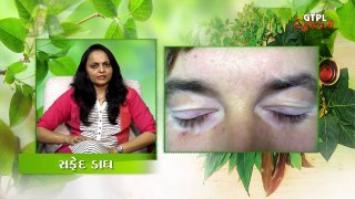 Safed Dagh or White Spot Home Remedies by Dr. Renuka Siddhapura