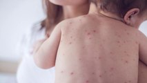 Epidemia e fruthit, mungesë e vaksinave në disa qytete