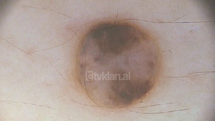 5500 raste te reja me kancer ne vit