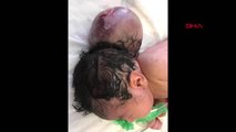 Beyin dokusu kese içinde doğan bebeğe operasyon