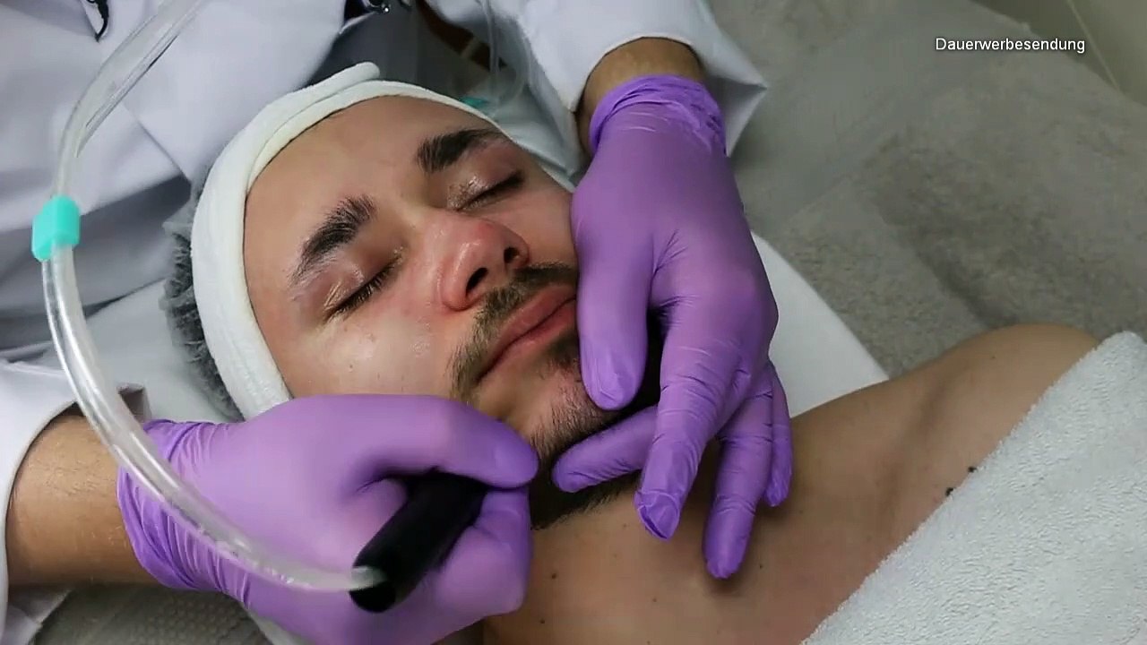 HydraCare bei Akne-Comedo | #hydracare #aknecomedo #dermaceutical