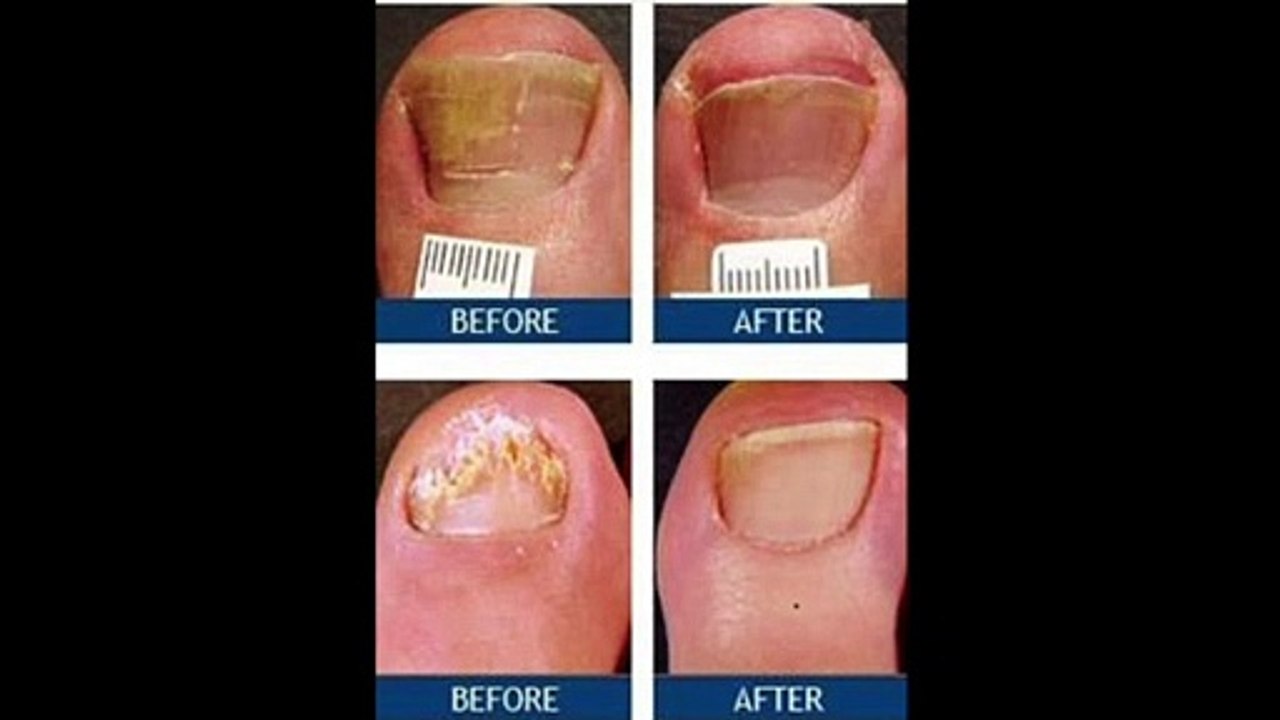 Laser Nail Treatment Overview