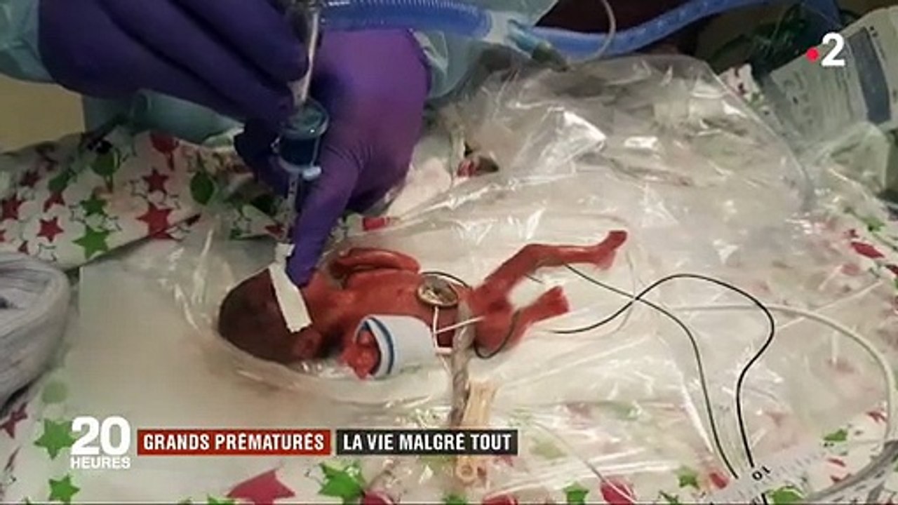 Bouleversant : Regardez le plus petit prématuré du monde qui ne pesait que 245gr à la naissance et dont les chances de survie étaient quasiment nulles