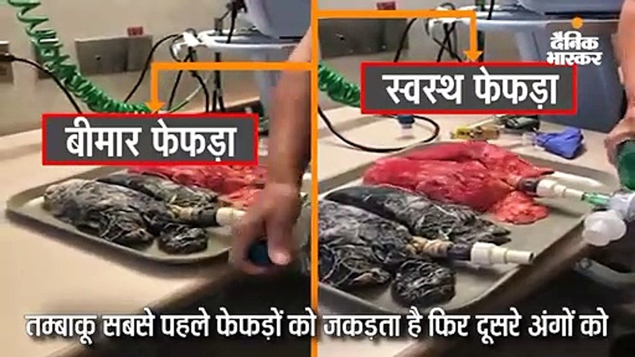 धूम्रपान के बाद बीमार फेफड़े की तस्वीर