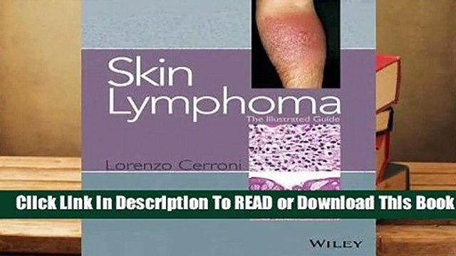 [Read] Skin Lymphoma: The Illustrated Guide For Full