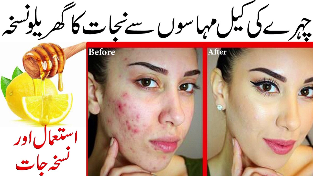 Acne Treatment || remove the acne scars at Home || چہرے کے داغ دھبے جڑ سے ختم
