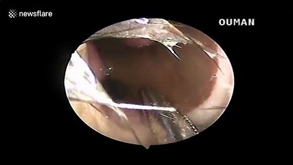 Il enlève.. une SANGSUE de son NEZ !!